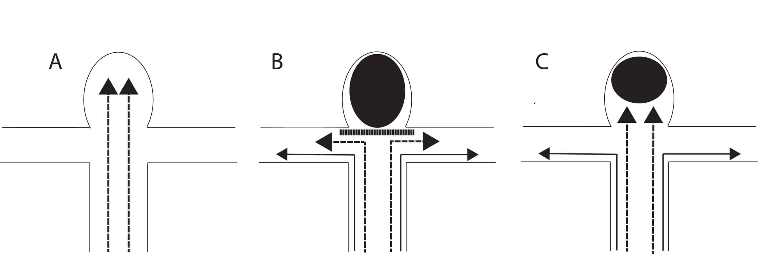 eCLIPs Medical Devices for Cerebral Aneurysm